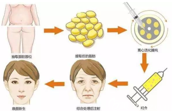 仁美面部脂肪填充 仁美面部脂肪填充