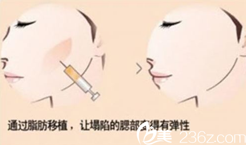 仁美面部脂肪填充的優(yōu)勢(shì) 仁美面部脂肪填充的優(yōu)勢(shì)