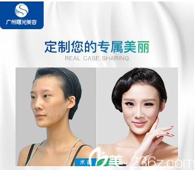 廣州曙光醫(yī)院萬友望醫(yī)生做的自體脂肪填充案例圖片