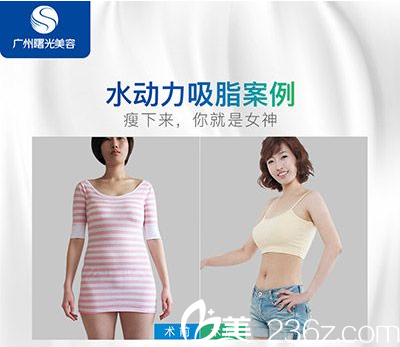 廣州曙光醫(yī)院萬友望主任做的吸脂案例圖片