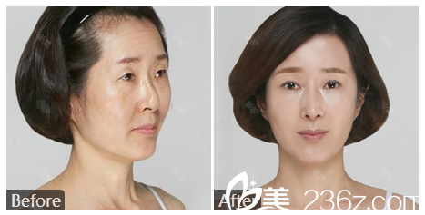 廣州曙光整形醫(yī)院陳天雷主任做的線雕埋線提升案例 廣州曙光整形醫(yī)院陳天雷主任做的線雕埋線提升案例