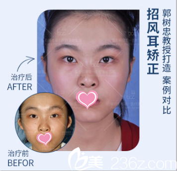 北京聯(lián)合麗格醫(yī)療美容醫(yī)院郭醫(yī)生招風(fēng)耳矯正效果