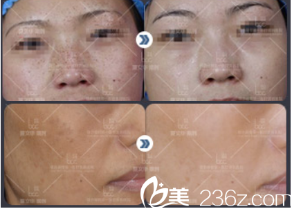 北京聯(lián)合麗格醫(yī)療美容醫(yī)院夏醫(yī)生案例