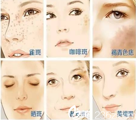 臉上斑點(diǎn)去不掉？南寧千美子激光祛斑1290元起幫你擁有白嫩肌膚