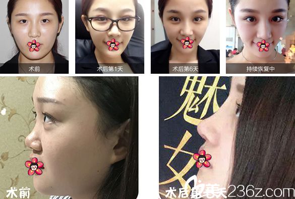 寧波壹秒整形眼鼻整形案例