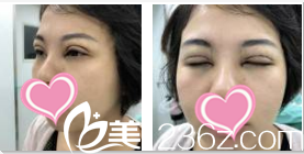 韓國(guó)TheBidan德碧亶整形外科醫(yī)院田景旭眼部整形術(shù)后第四天效果