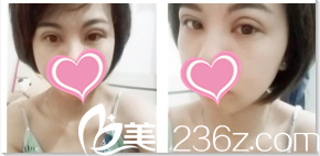 韓國(guó)TheBidan德碧亶整形外科雙眼皮開眼角術(shù)后13天效果