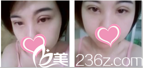 韓國(guó)TheBidan德碧亶整形外科醫(yī)院艾雙眼皮開眼角術(shù)后第28天樣子