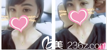 分享我在韓國TheBidan德碧亶整形醫(yī)院找田景旭做切開雙眼皮+開眼角第35天效果