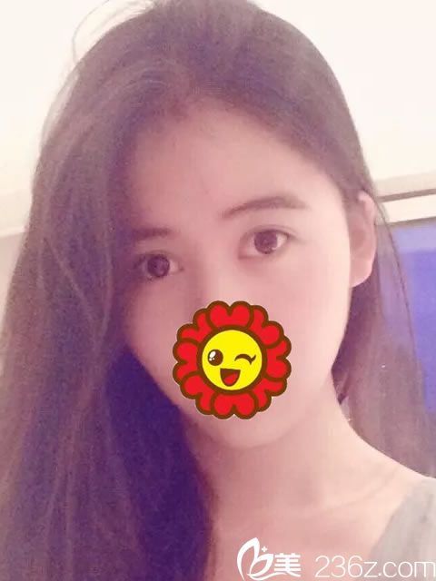 義烏張小紅雙眼皮案例效果 義烏張小紅雙眼皮案例效果