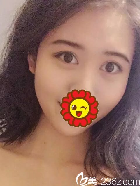 義烏張小紅整形醫(yī)院全切雙眼皮+開眼角綜合手術(shù)經(jīng)歷 圓了學(xué)生時(shí)代的雙眼皮夢(mèng)