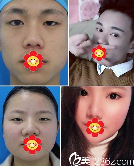 寧波時光美極張寶琳雙眼皮案例 寧波時光美極張寶琳雙眼皮案例