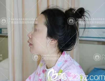 南寧愛思特頜面整形手術(shù)后5天 南寧愛思特頜面整形手術(shù)后5天