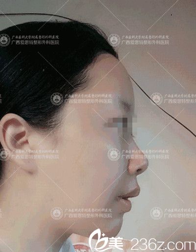 南寧愛思特頜面整形手術(shù)后14天 南寧愛思特頜面整形手術(shù)后14天