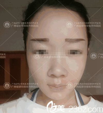 南寧愛思特頜面整形手術(shù)后20天 南寧愛思特頜面整形手術(shù)后20天