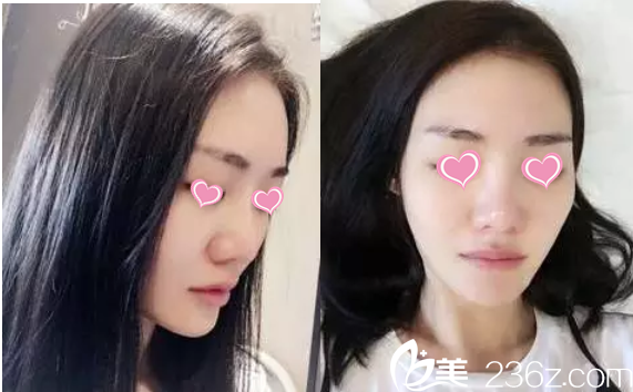 <!--<i data=20240703-sp></i>-->整形隆鼻案例 <!--<i data=20240703-sp></i>-->整形隆鼻案例