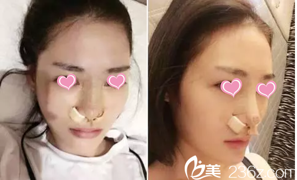 鄒琪醫(yī)生隆鼻案例 鄒琪醫(yī)生隆鼻案例