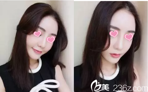 隆鼻后20天效果 隆鼻后20天效果