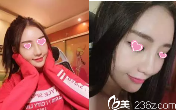 術(shù)后一個(gè)月 術(shù)后一個(gè)月