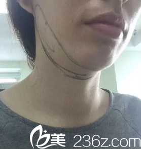 這是醫(yī)生畫(huà)線的時(shí)候 這是醫(yī)生畫(huà)線的時(shí)候