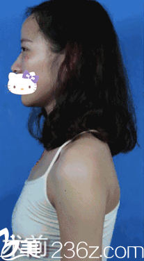 假體隆胸術(shù)前照 假體隆胸術(shù)前照