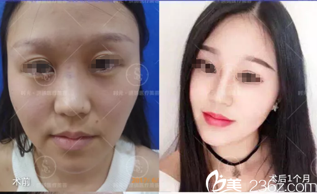 周長兵鼻綜合案例 周長兵鼻綜合案例