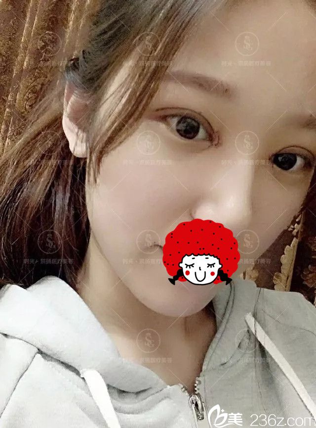 拆掉紗布第二天眼部恢復(fù) 拆掉紗布第二天眼部恢復(fù)