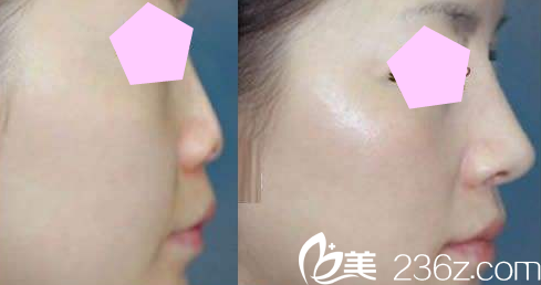 太原歐美蓮張世民隆鼻案例效果圖 太原歐美蓮張世民隆鼻案例效果圖