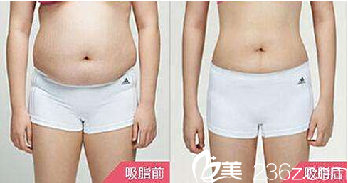 歐美蓮張世民腰腹部抽脂減肥塑形效果圖 歐美蓮張世民腰腹部抽脂減肥塑形效果圖