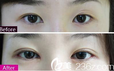 太原歐美蓮白立明雙眼皮失敗修復案例效果對比圖