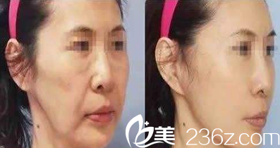 歐美蓮白立明線雕面部提升案例效果圖