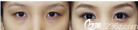 北京上上相醫(yī)療美容醫(yī)院雙眼皮效果
