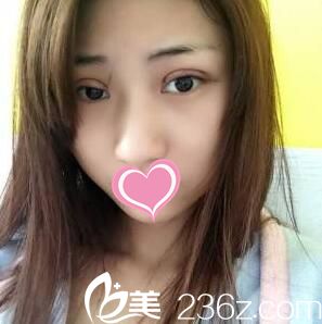 割雙眼皮術(shù)后當天照片