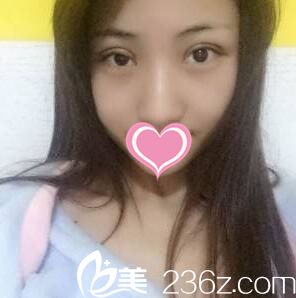 雙眼皮第三天恢復情況