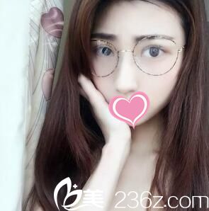 割雙眼皮20天恢復情況