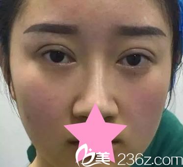 切開雙眼皮天效果 切開雙眼皮天效果