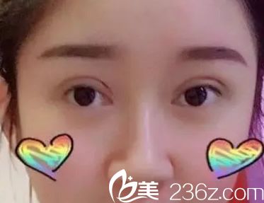 切開雙眼皮第十天的效果 切開雙眼皮第十天的效果