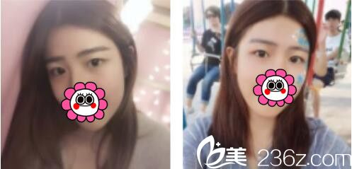 韓國BY整形外科蔡秀旭韓式雙眼皮真人案例術(shù)前照 韓國BY整形外科蔡秀旭韓式雙眼皮真人案例術(shù)前照