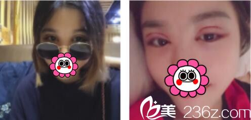 韓國BY整形外科蔡秀旭韓式雙眼皮真人案例術(shù)后第三天 韓國BY整形外科蔡秀旭韓式雙眼皮真人案例術(shù)后第三天