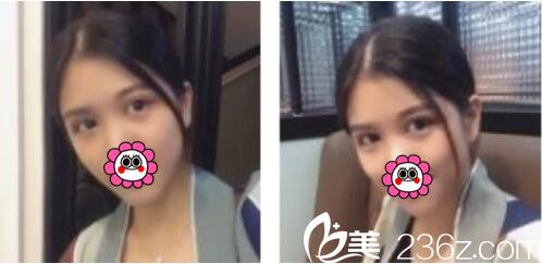 韓國BY整形外科蔡秀旭韓式雙眼皮真人案例術(shù)后一個(gè)月 韓國BY整形外科蔡秀旭韓式雙眼皮真人案例術(shù)后一個(gè)月