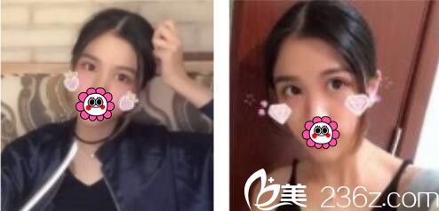 韓國BY整形外科蔡秀旭韓式雙眼皮真人案例術(shù)后兩個(gè)月 韓國BY整形外科蔡秀旭韓式雙眼皮真人案例術(shù)后兩個(gè)月