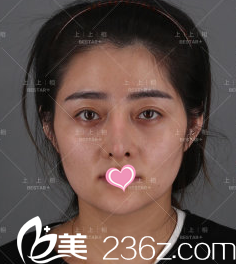 北京上上相醫(yī)療美容面部脂肪填充修復(fù)術(shù)前照 北京上上相醫(yī)療美容面部脂肪填充修復(fù)術(shù)前照
