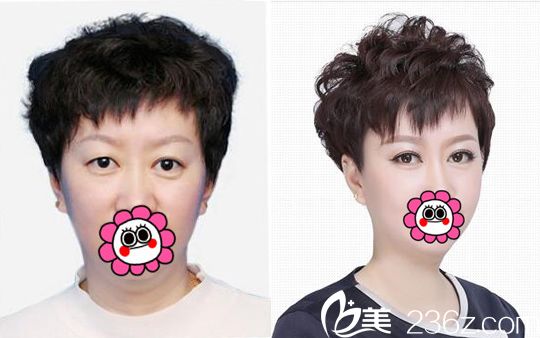 吉林市中妍整形雙眼皮手術(shù)案例