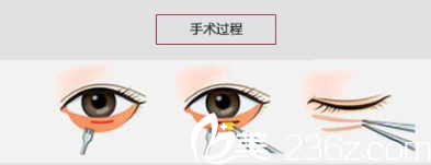 祛眼袋的手術(shù)方法