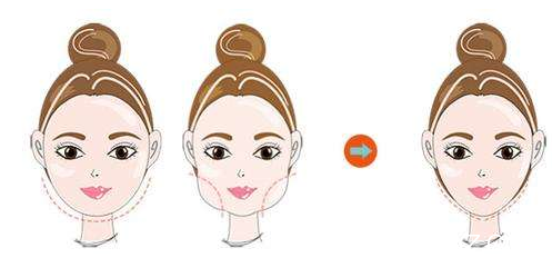 面部吸脂瘦臉優(yōu)勢 面部吸脂瘦臉優(yōu)勢