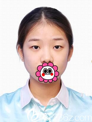 吉林市中妍雙眼皮手術(shù)案例 吉林市中妍雙眼皮手術(shù)案例