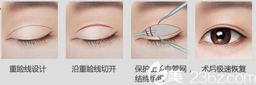 吉林市中妍全切雙眼皮手術(shù)方法 吉林市中妍全切雙眼皮手術(shù)方法