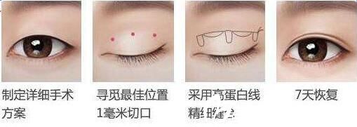 吉林市中妍韓式雙眼皮手術(shù)方法 吉林市中妍韓式雙眼皮手術(shù)方法