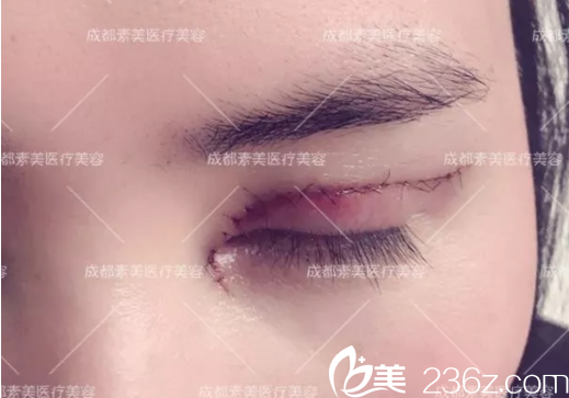 楊迪帕克雙眼皮術(shù)后即刻特寫 楊迪帕克雙眼皮術(shù)后即刻特寫