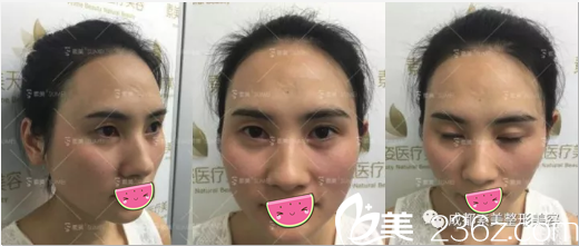 <!--<i data=20240703-sp></i>-->雙眼皮術(shù)前照片 <!--<i data=20240703-sp></i>-->雙眼皮術(shù)前照片